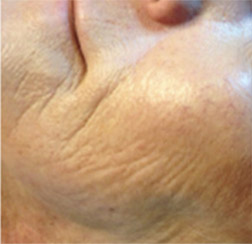 Before microneedling on face