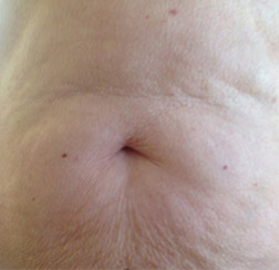 Before microneedling on stomach