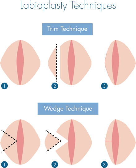 labiaplasty techniques diagram