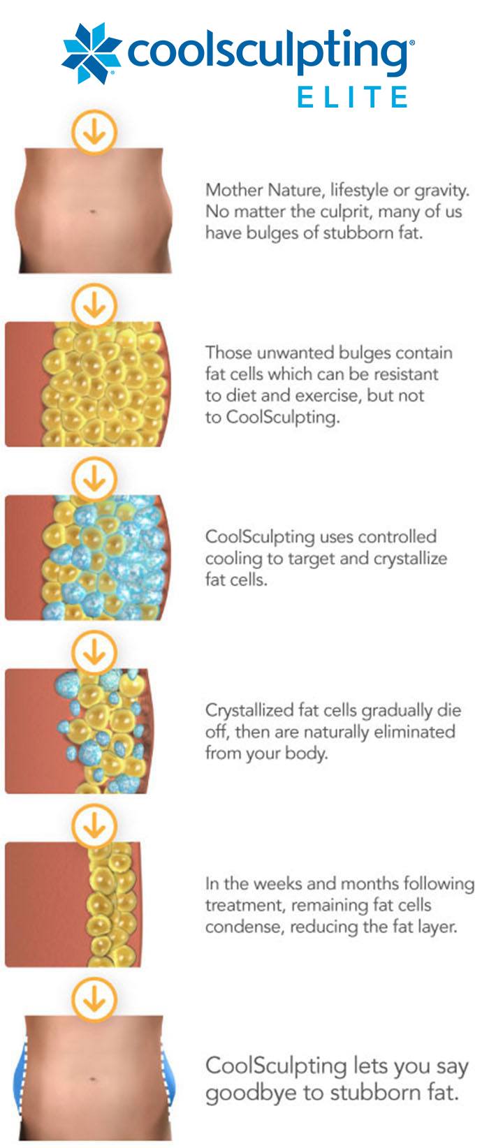 CoolSculpting Elite steps of how it works