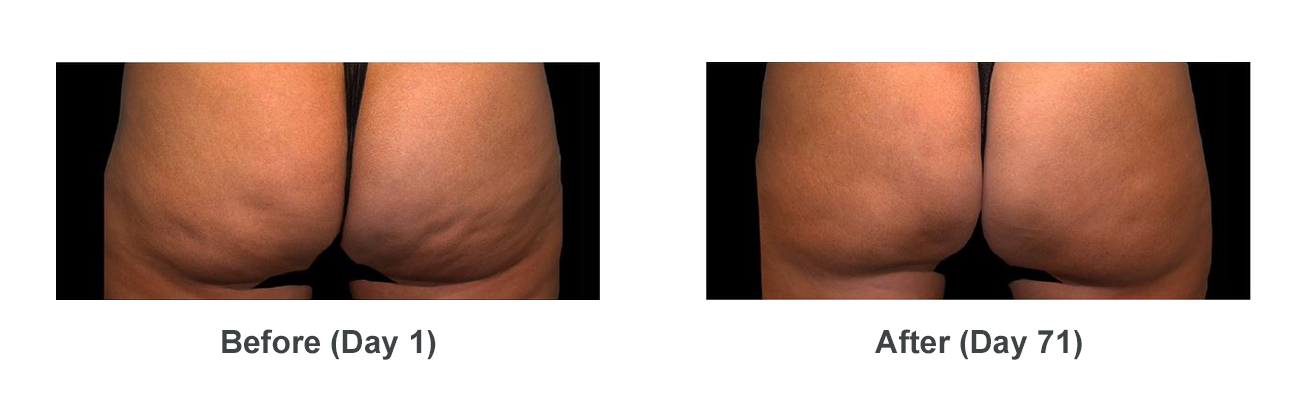 Before and 71 days after QWO treatment of cellulite on female buttocks