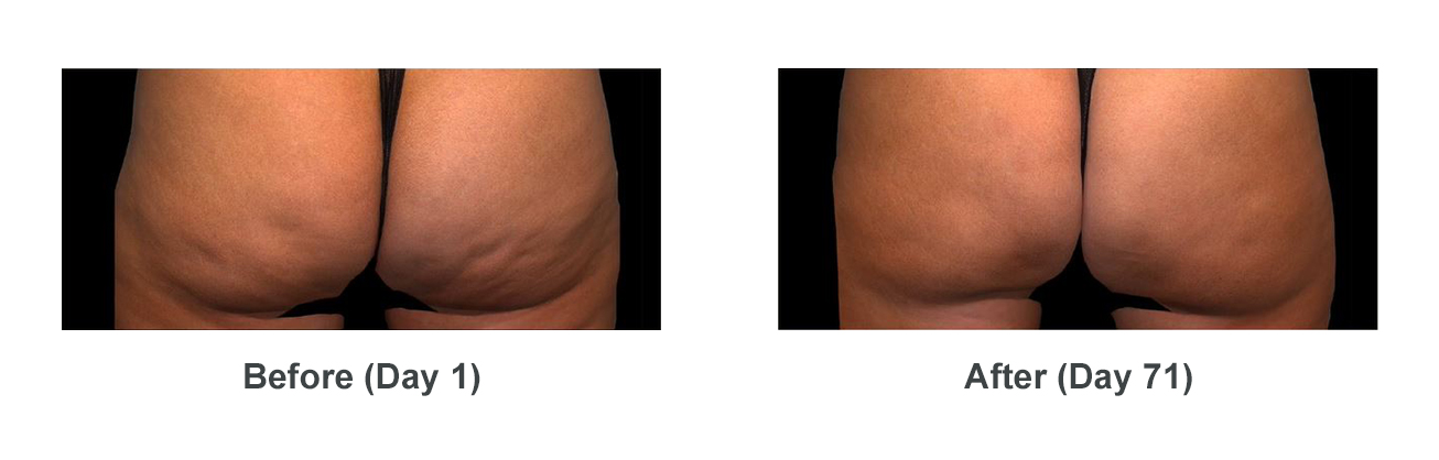 Before and 71 days after QWO treatment of cellulite on female buttocks