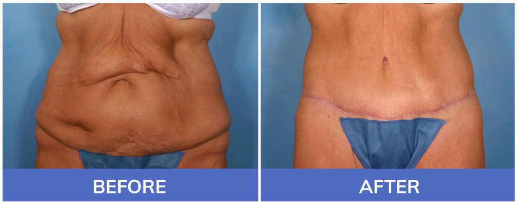 Tummy Tuck Before-and-After