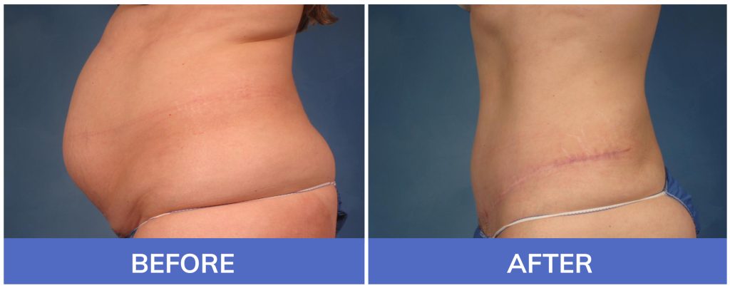 Tummy Tuck Before-and-After