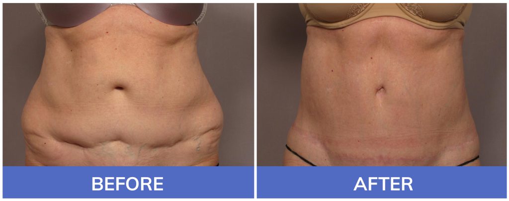 Tummy Tuck Before-and-After