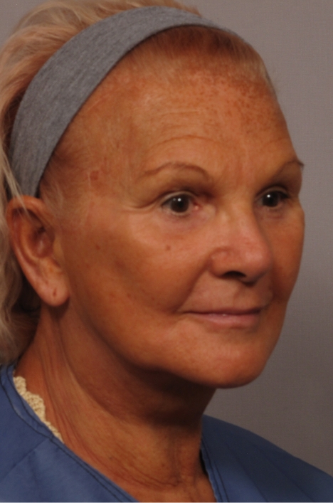 side of woman's face after facial rejuvenation surgery