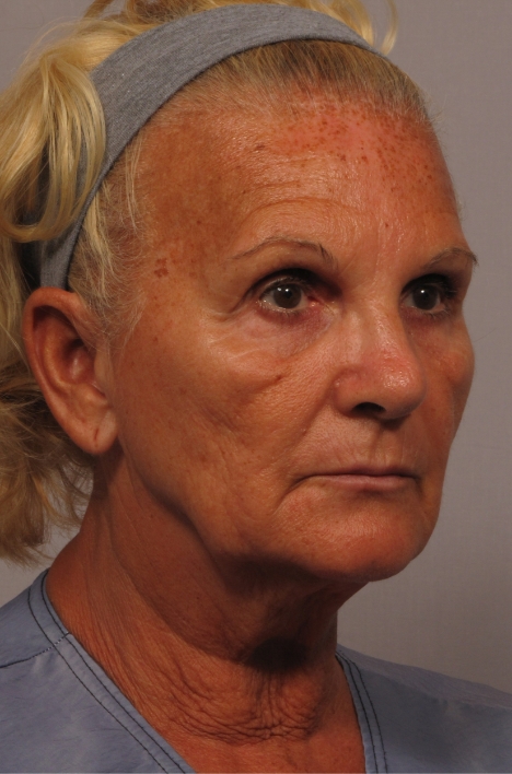 side of woman's face before facial rejuvenation surgery