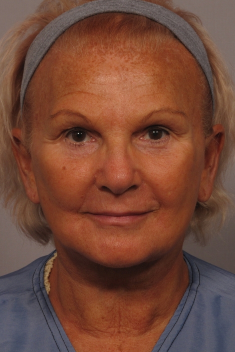 front of woman's face after facial rejuvenation surgery