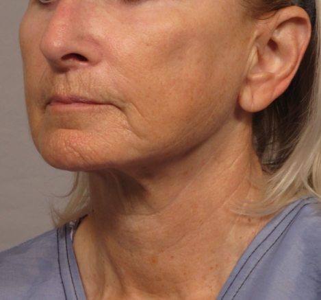 side of woman's face after facial rejuvenation surgery
