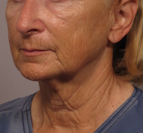 side of woman's face before facial rejuvenation surgery