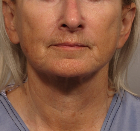 front of woman's face after facial rejuvenation surgery