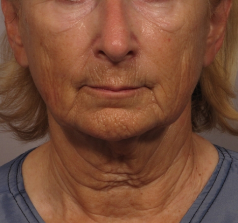front of woman's face before facial rejuvenation surgery