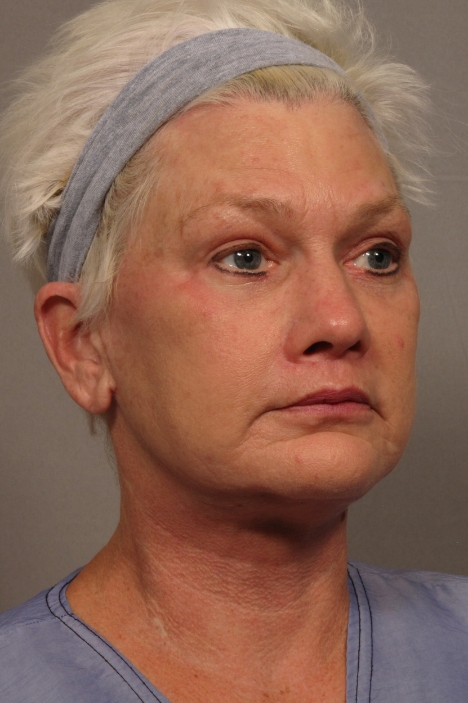 side of woman's face after facial rejuvenation surgery