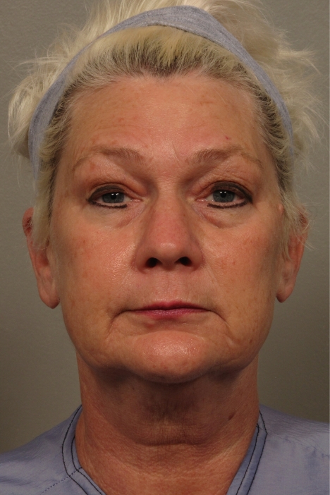 front of woman's face before facial rejuvenation surgery