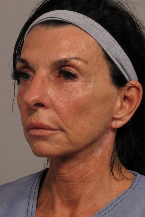 side of woman's face after facial rejuvenation surgery