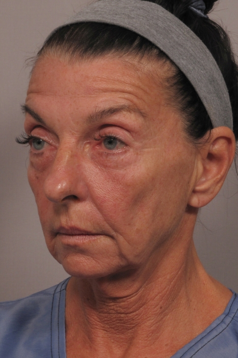 side of woman's face before facial rejuvenation surgery