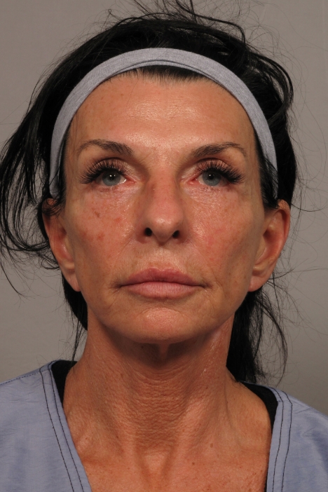 front of woman's face after facial rejuvenation surgery