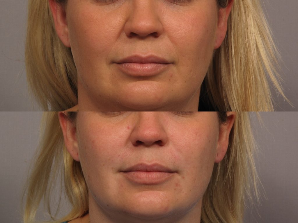 woman's smile lines before and after 1 syringe of Juvederm® Vollure