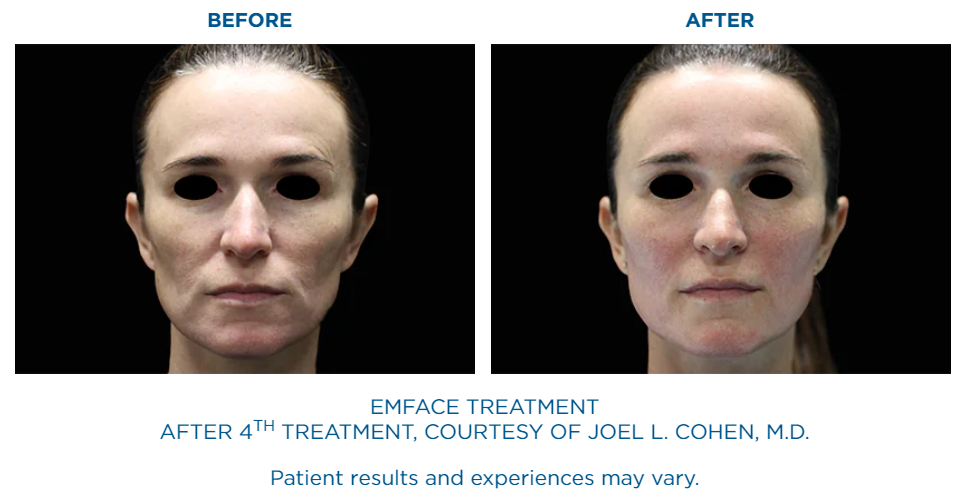 woman's face before and after 4th Emface treatment