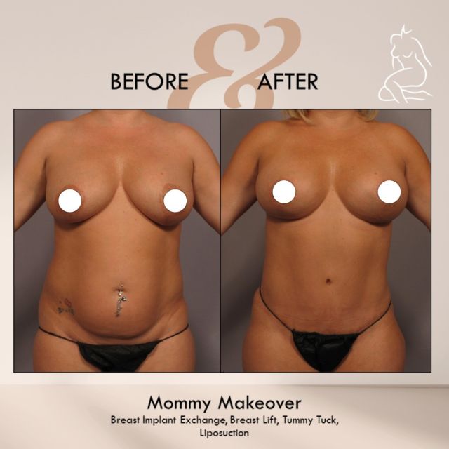 𝗙𝗨𝗟𝗟 Body Transformation🔥

This beautiful 42-year-old female patient had two pregnancies! 

Dr. Hasen performed a Mommy Makeover on her, including several procedures, with just ONE recovery! 😍

1️⃣Abdominoplasty (tummy tuck) with #diastasisrectirepair 
2️⃣Breast Implant Exchange with 345cc Saline Breast 3️⃣Revision Breast Lift 
4️⃣Liposuction for #bodycontouring 

Interested in a consultation with @dr.naples ⁉️
Please call us at 239-262-5662 or DM us! 

Follow our office accounts💙 
@aestheticrn_dr.naples 
@aesthetician_dr.naples 
@injector_dr.naples 

#mommymakeover #mommymakeoversurgery #mastopexy #breastlift #breastimplantexchange #tummytuck #tummytucksurgery #liposuction #bodycontouring #salinebreastimplants #siliconebreastimplants #boardcertifiedplasticsurgeon #plasticsurgeonnaples #plasticsurgerycenter #medspa #momsofcolliercounty #fullbodytransformation #naplesfl #colliercounty