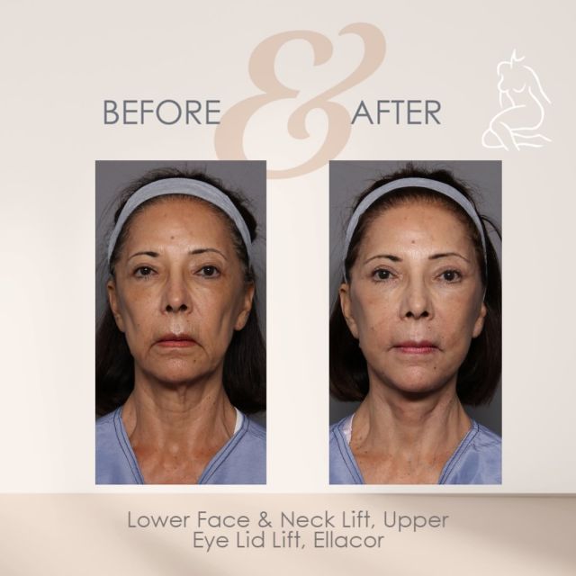 Transformation Thursday 🤩

This patient only 3 months post op, she wanted overall facial rejuvenation by Dr.Hasen to give her a more refreshed and youthful look; job accomplished! 

Dr.Hasen performed an upper eye lid lift #blepharoplasty to address her upper eye lid excess skin and fat.

To help her perioral lines Dr.Hasen performed Ellacor microcoring to the central mouth area, topped with #Exosomes 

Exosomes: reduce redness, reduces scarring, stimulates collagen, and improves the overall skin texture! 

Lastly, to address her neck laxity and jowling, Dr.Hasen performed a face and neck lift with extended SMAS flap and submental contouring! 

A SMAS flap facelift lifts and tightens the underlying muscles of the midrange, lower face and neck to help restore the cheeks, eliminate jowls and contour the jawline and neck. It also removes excess skin, while smoothing wrinkles and folds in the skin that remains! 

After everything, this patient was thrilled with the outcome and we’re so glad she trusted us throughout the process! 

#facelift #blepharoplastysurgery #uppereyelidlift #ellacor #exosomes #smasflapfacelift #deepplanefacelift #boardcertifiedplasticsurgeon #plasticsurgerycenterofnaples #submentalcontouring #facialrejuventation #facialtransformation #beforeandafter #swfl