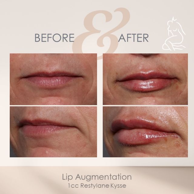 Stop waiting! Treat yourself to the lips you’ve always wanted!

1cc of Restylane Kysse was used during her treatment. 

Lips injected by Dr.Hasen 👄

Call 239-262-5662 to book your appointment! 

#restylanekysse #lipsbydrhasen #lipaugmentation #plumplips #kysse #lipfiller #lipfillerbeforeandafter #galderma