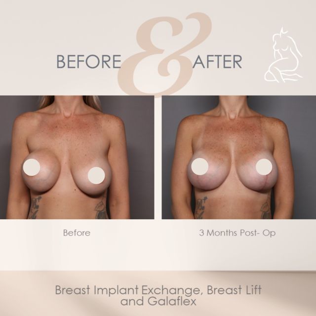 Are you ready for boats and bikinis? 🛥️ 👙

Dr. Hasen performed a Breast Implant Exchange, Breast Lift and added an internal bra called Galaflex!

Call 239-262-5662 to schedule a consultation with Board Certified Plastic Surgeon, Dr. Hasen!

#summerbody #swfl #bikinibody #breastimplantexchange #siliconebreastimplants #breastlift #mastopexy #galaflex #galaflexmesh #galaflexinternalbra #naplesflorida #marcoisland #esteroflorida #boardcertifiedplasticsurgeron #plasticsurgery #operatingroom #cosmeticsurgeryforwomen