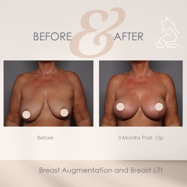 Bikini- ready Breasts 👙

Whether old age, babies, or just small breasts are your concern, cosmetic breast surgery can help you achieve your bikini body in a way that will make you want to spend all summer by the beach or pool! 

To learn more about the different cosmetic breast enhancement options, contact us today 239-262-5662!