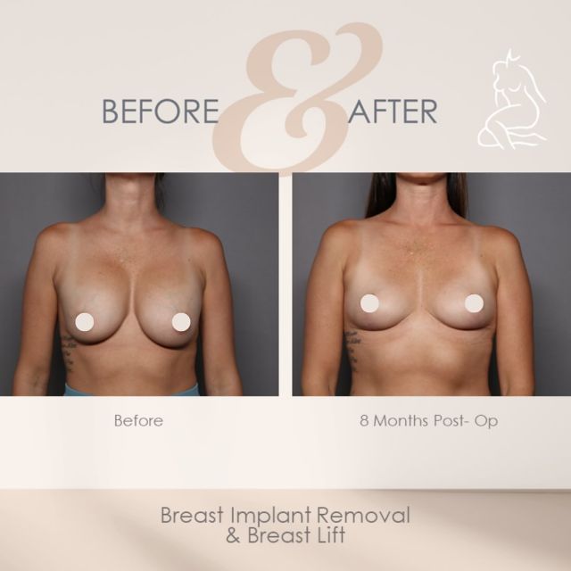 Summer Refresh 🔄 😍 

Check out these amazing Breast Implant Removal and Breast Lift results performed by Board Certified Plastic Surgeon, Dr.Hasen! 

#breastimplantremoval  #mastopexy #boardcertifiedplasticsurgeons #plasticsurgeryconsultation #plasticsurgerycenterofnaples #operatingsuite #capsulectomy #swflbreastsurgeon #plasticsurgerybeforeandafter